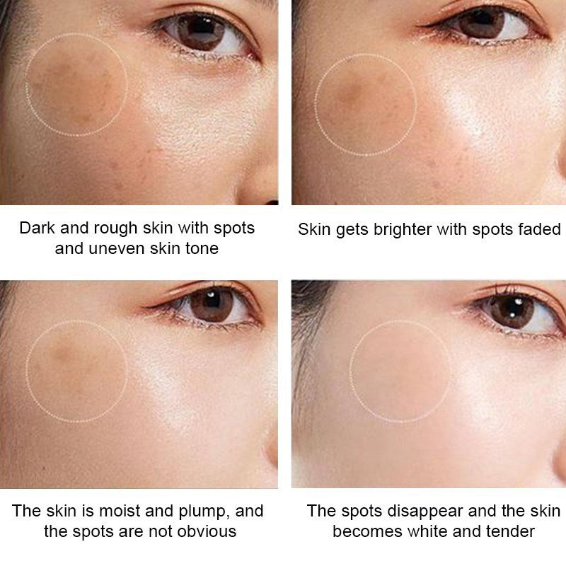 Powerful Whitening Freckle Cream Remove Acne Spots Melanin Dark Spots Face Lift Firming Face Skin Care Beauty Essentials